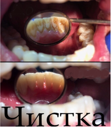 Гигиена полости рта